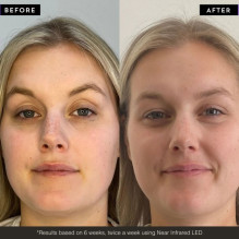 PHOTON LED Light Therapy Face Mask LED veido kaukė, 1vnt