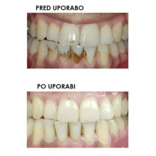 Silkn ToothWave TW1PE3001